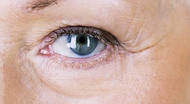 علائم خشکی پوست زیر چشم