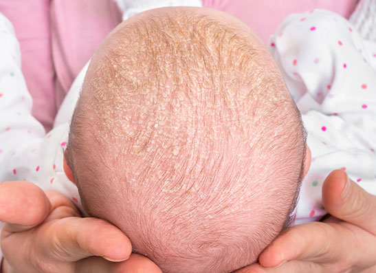 خشکی پوست بهاری در نوزادان