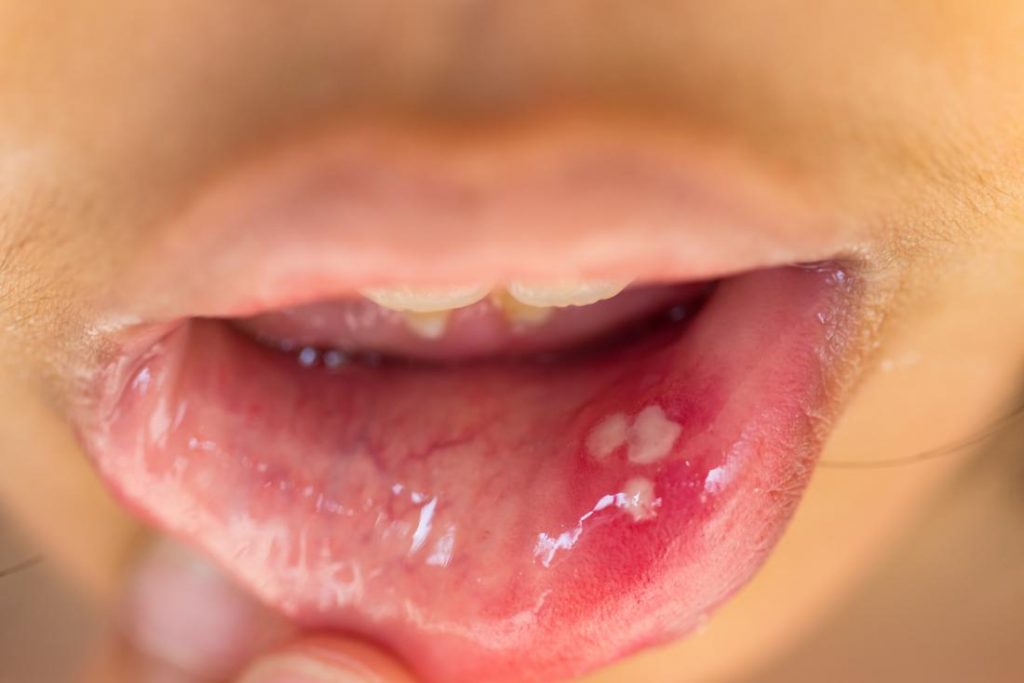 علائم HPV یا زگیل تناسلی در دهان
