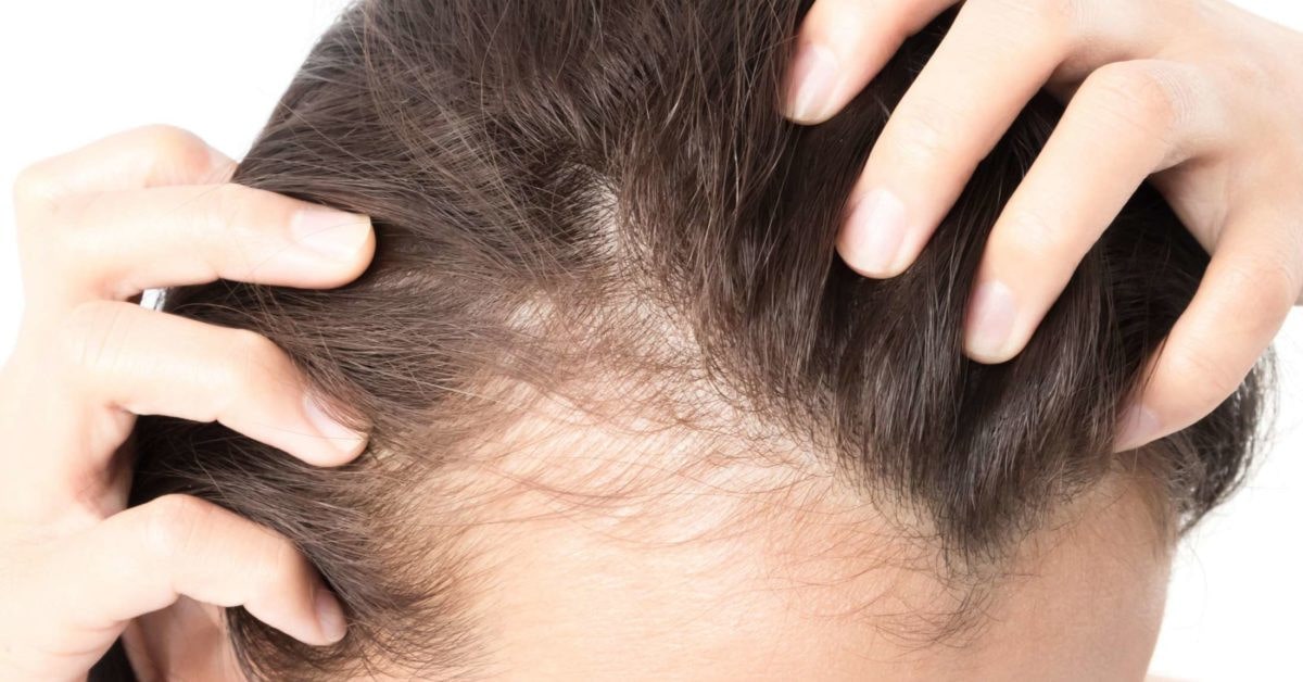 کاهش ریزش مو ارثی: آغاز ریزش مو از جلوی سر