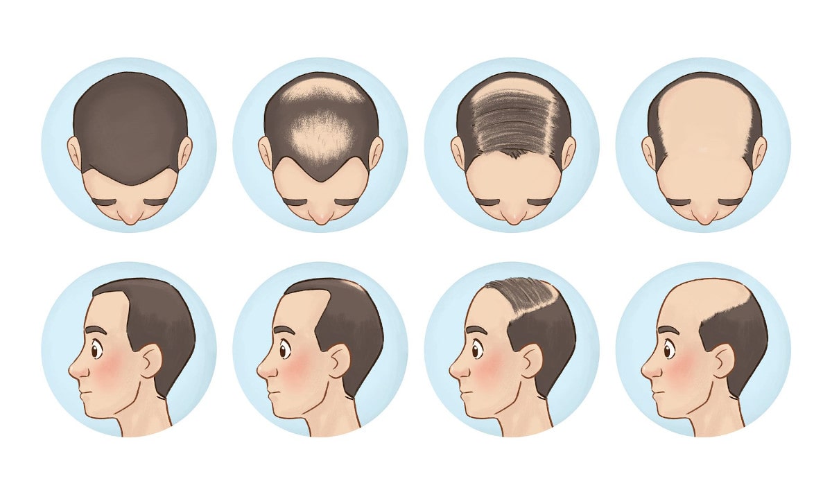 کاهش ریزش مو ژنتیکی: الگو‌های مختلف ریزش مو مردانه