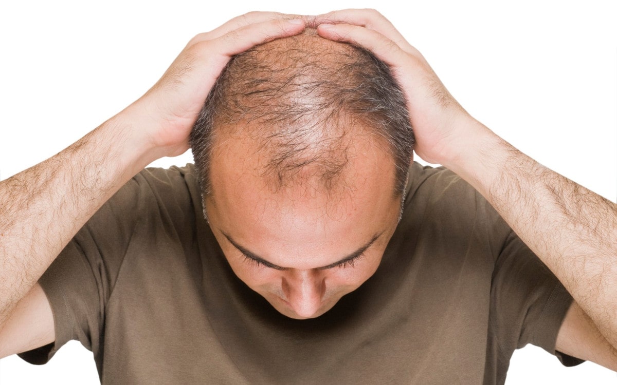 کاهش ریزش مو ارثی: استفاده از قرص و شامپو
