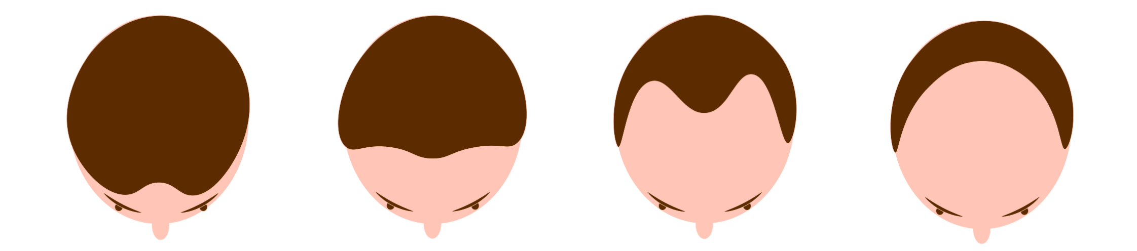 الگوی ریزش مو مردان، خط جلو پیشانی و بالای سر 