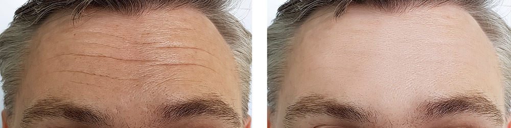 تصویر قبل و بعد لیفت ابرو مردان با جراحی