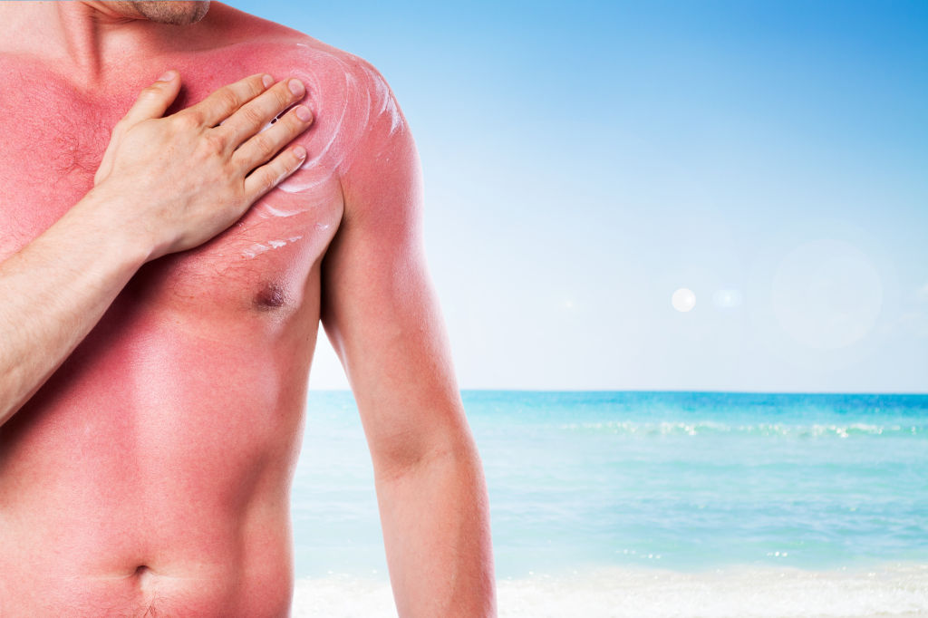 استفاده کردن از ژل آفتاب سوختگی بعد از سوختن پوست بدن